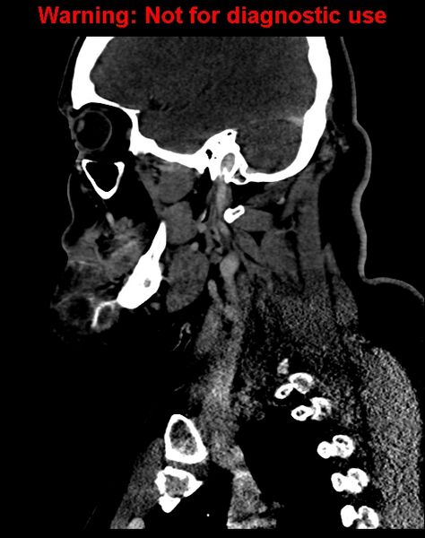 File:Ameloblastoma (Radiopaedia 33126-34164 F 49).jpg
