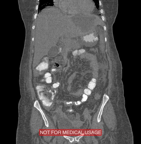 File:Amoebic enterocolitis with liver abscess (Radiopaedia 35100-36609 B 74).jpg