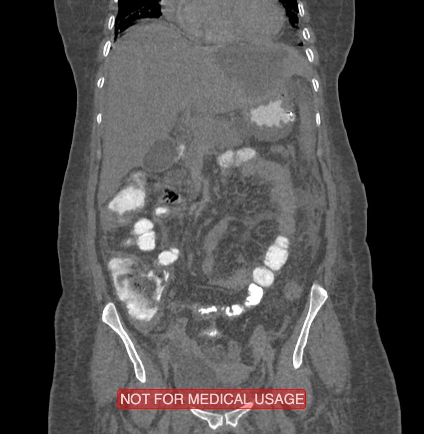 Amoebic enterocolitis with liver abscess (Radiopaedia 35100-36609 B 74).jpg