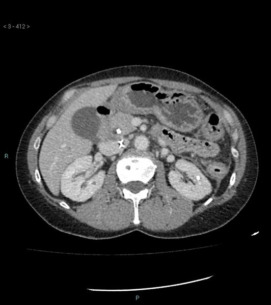 File:Ampulla of Vater metastasis (Radiopaedia 27820-28069 A 50).jpg