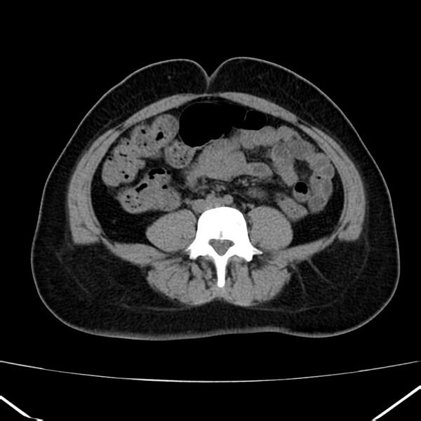 File:Ampullary tumor (Radiopaedia 22787-22816 Axial non-contrast 34).jpg