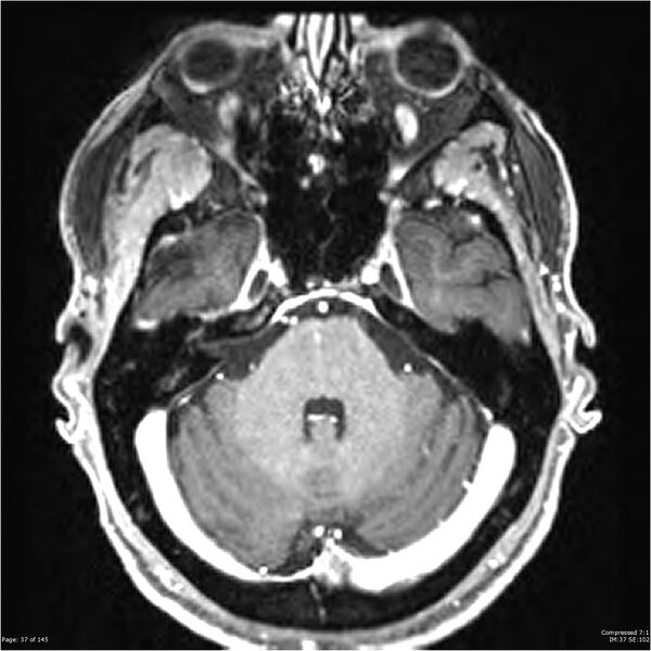 File:Anaplastic meningioma with recurrence (Radiopaedia 34452-35788 Axial T1 C+ 37).jpg