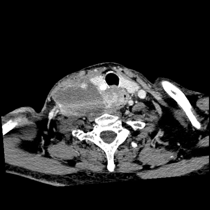 Anaplastic thyroid carcinoma (Radiopaedia 79087-92034 B 42).jpg