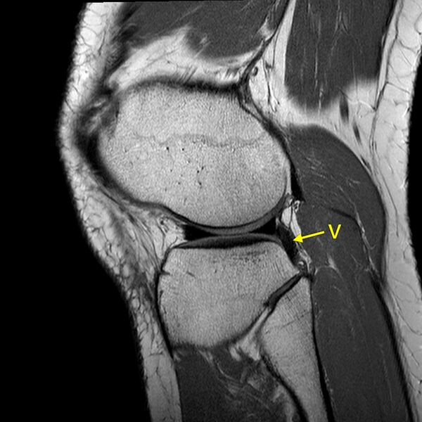 File:Anatomy Quiz (MRI knee) (Radiopaedia 43478-46865 A 21).jpeg