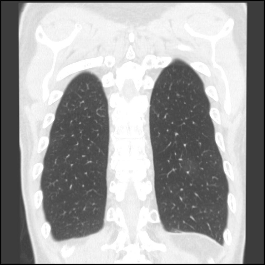 Angioinvasive aspergillosis (Radiopaedia 43957-47466 Coronal lung window 13).jpg