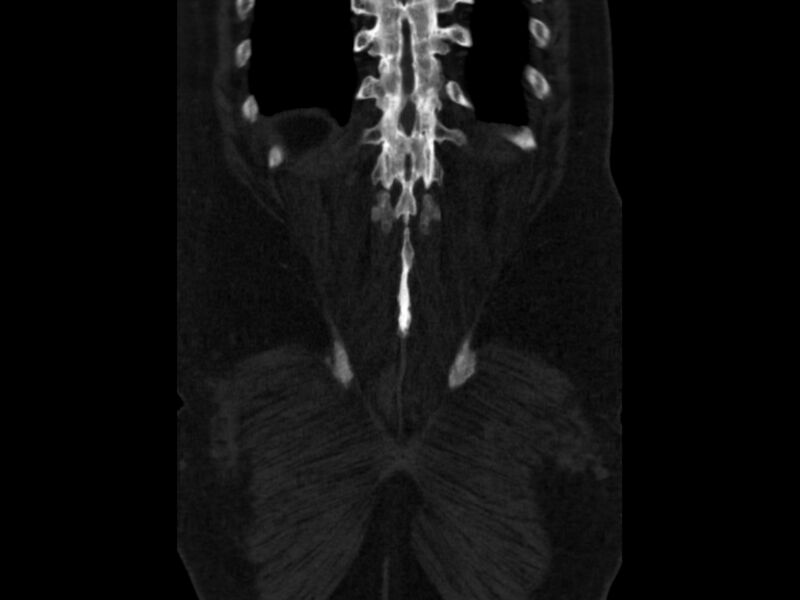 File:Ankylosing spondylitis (Radiopaedia 44609-48357 Coronal bone window 94).jpg