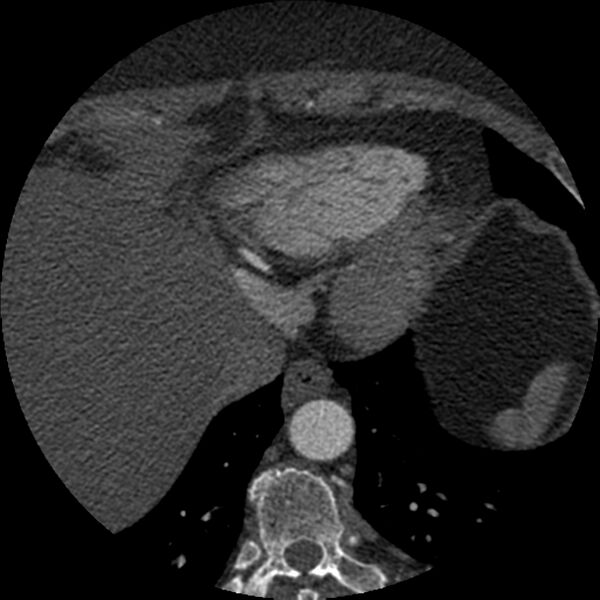 File:Anomalous origin of left circumflex artery from right coronary sinus (Radiopaedia 72563-83117 B 155).jpg