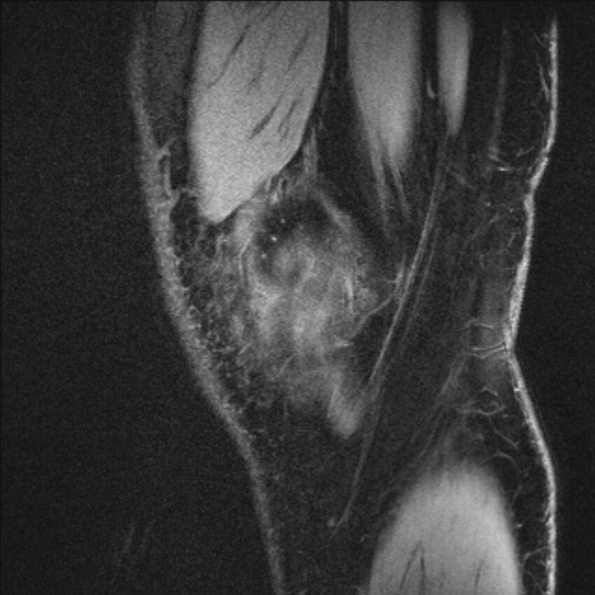Anterior cruciate ligament mucoid degeneration (Radiopaedia 68400-77933 Sagittal 62).jpg