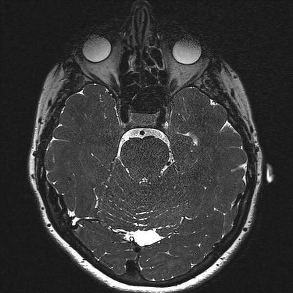 File:Anterior temporal encephalocele (Radiopaedia 82624-96808 Axial T2 high res 63).jpg