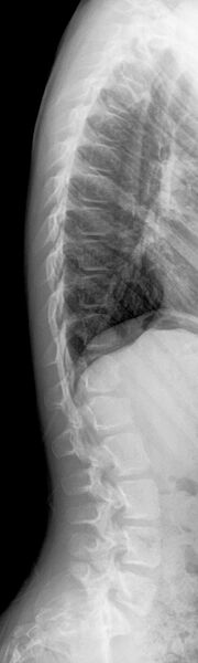 File:Anterior vertebral beaking secondary to trauma (Radiopaedia 24323-24605 Lateral 1).jpg