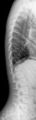 Anterior vertebral beaking secondary to trauma (Radiopaedia 24323-24605 Lateral 1).jpg