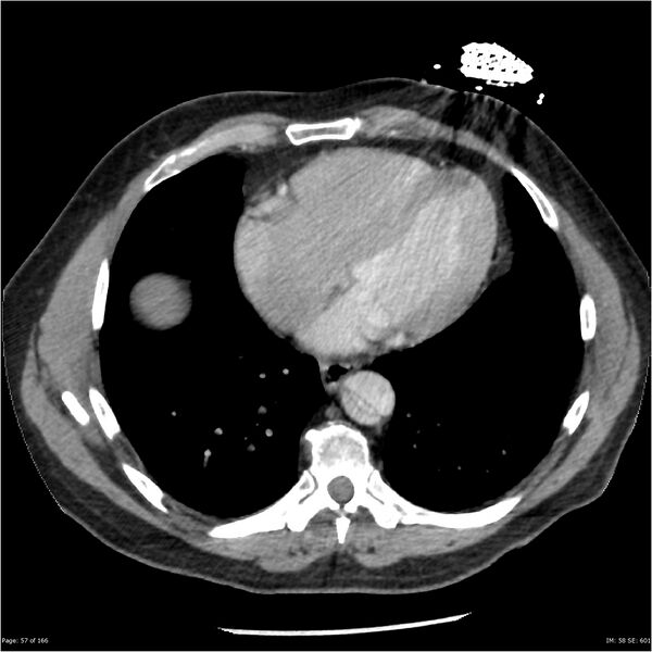 File:Aortic dissection- Stanford A (Radiopaedia 37759-39664 A 48).jpg