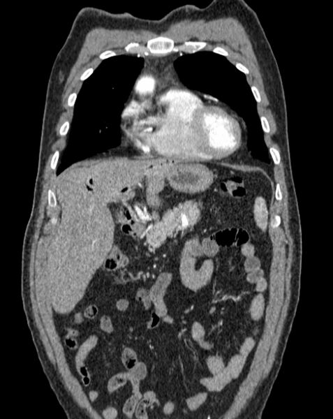 File:Aortic dissection (Radiopaedia 44411-48061 A 1).jpg