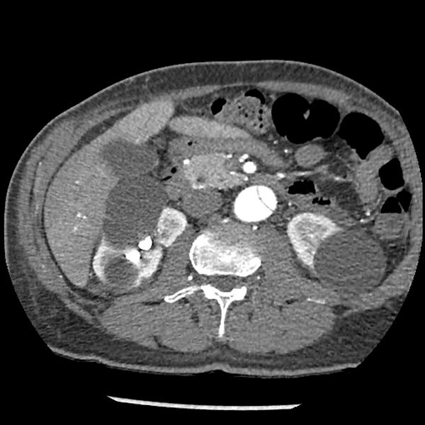 File:Aortic dissection - DeBakey Type I-Stanford A (Radiopaedia 79863-93115 A 50).jpg