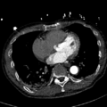 Aortic dissection - DeBakey type II (Radiopaedia 64302-73082 A 60).png