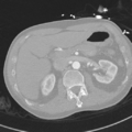 Aortic dissection - DeBakey type II (Radiopaedia 64302-73082 Axial lung window 68).png