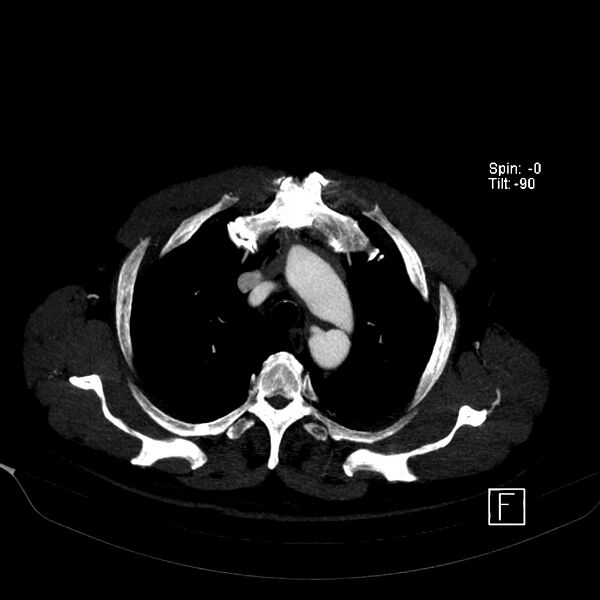 File:Aortic dissection - De Bakey type III - Stanford B (Radiopaedia 21903-21882 B 14).jpg