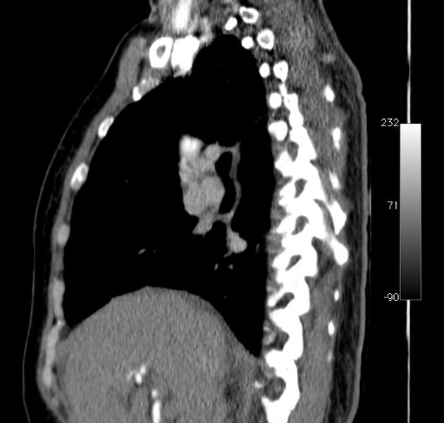 File:Aortic dissection - Stanford type A (Radiopaedia 29247-29659 C 38).jpg