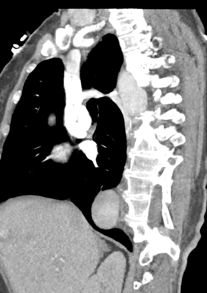 File:Aortic dissection - Stanford type B (Radiopaedia 50171-55512 C 39).png