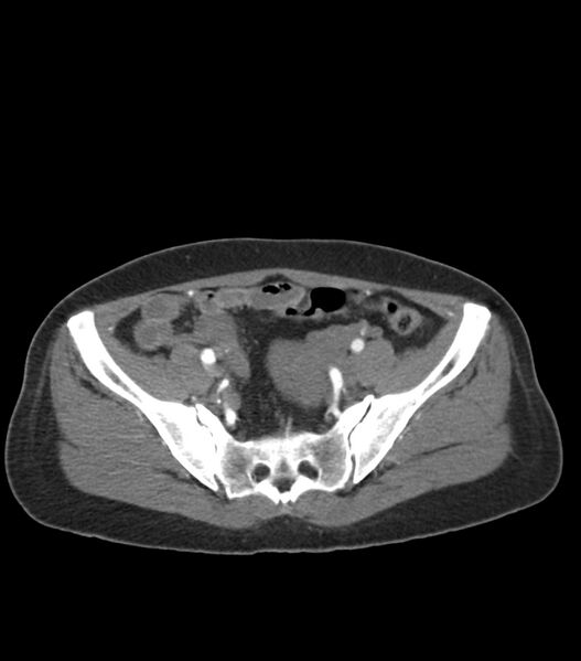 File:Aortic dissection with renal ischemia (Radiopaedia 76573-88338 A 96).jpg