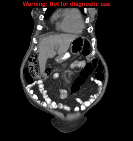 File:Aortic graft infection (Radiopaedia 44979-48907 non-contrast 11).jpg