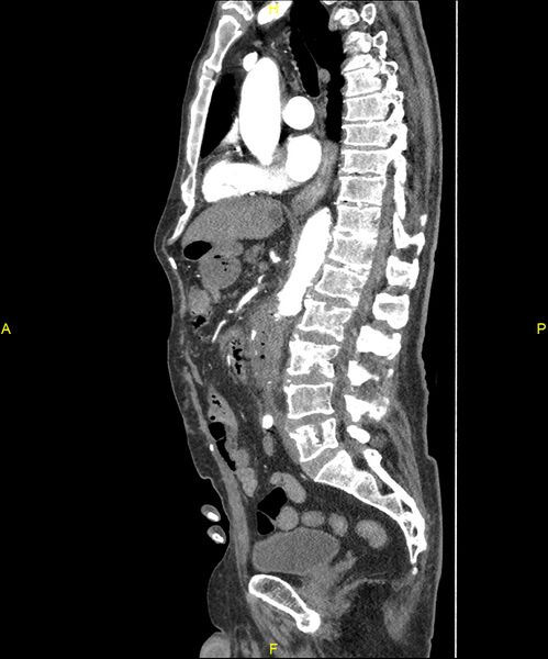 File:Aortoenteric fistula (Radiopaedia 84308-99603 C 176).jpg