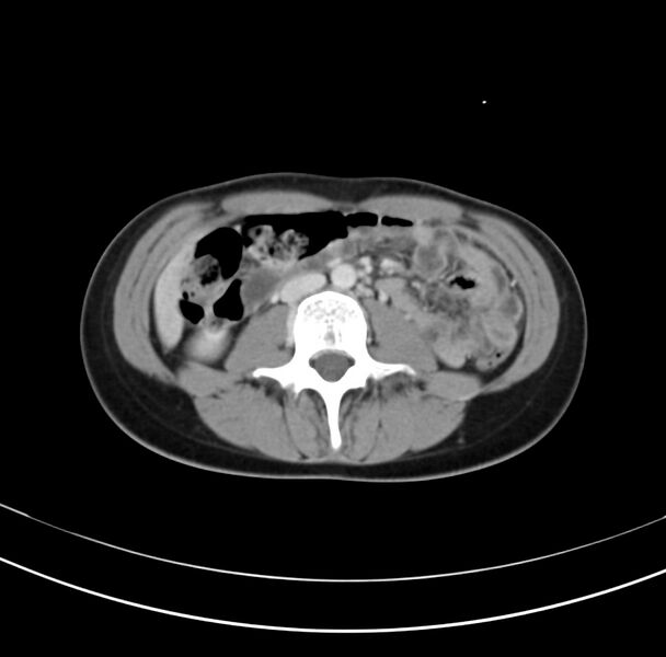 File:Appendicitis and incidental bicornuate uterus (Radiopaedia 22833-22853 B 22).jpg
