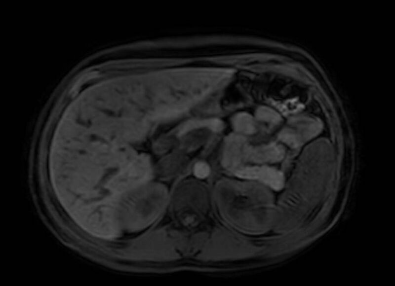 File:Appendicitis in gravida (MRI) (Radiopaedia 89433-106395 Axial DIXON 34).jpg