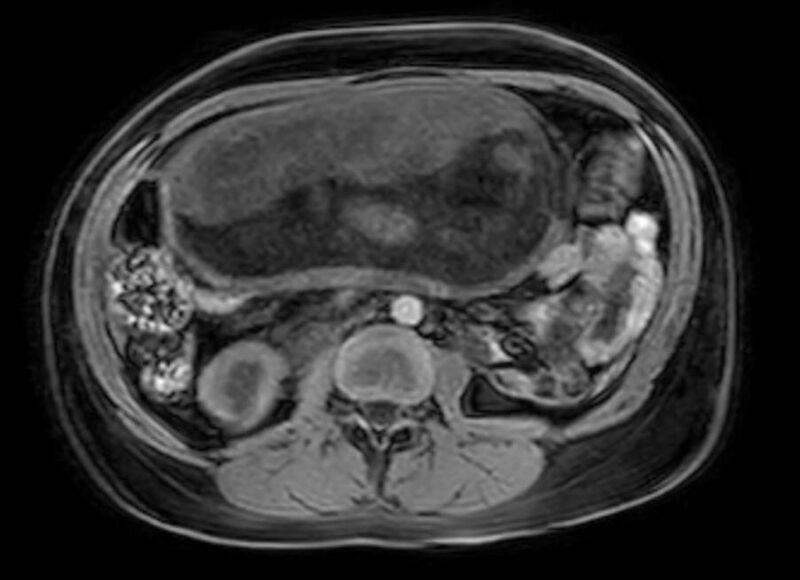 File:Appendicitis in gravida (MRI) (Radiopaedia 89433-106395 Axial DIXON 65).jpg