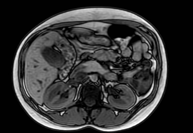 File:Appendicitis in gravida (MRI) (Radiopaedia 89433-106395 D 22).jpg