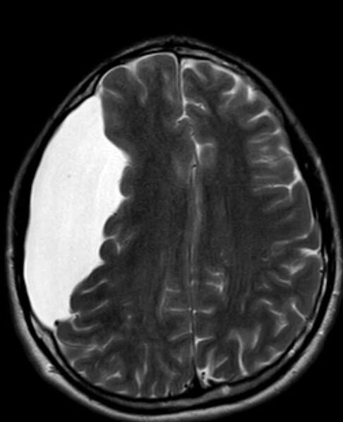 File:Arachnoid cyst- extremely large (Radiopaedia 68741-78451 Axial T2 18).jpg