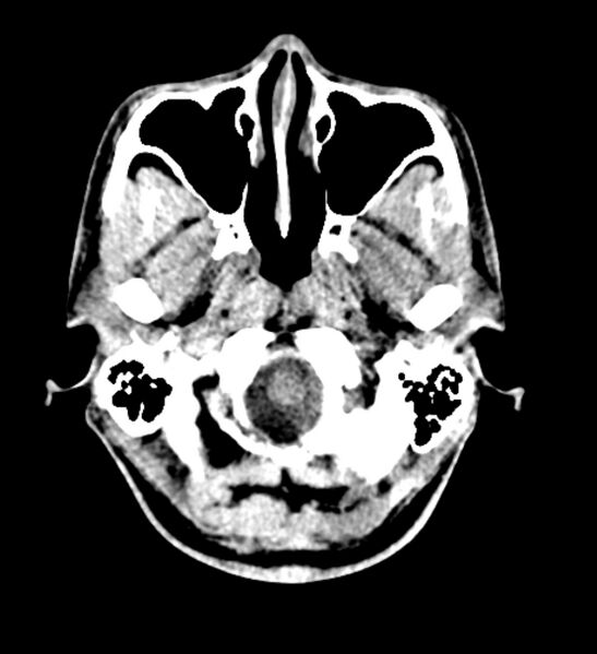 File:Arachnoid cyst of the ambient cistern (Radiopaedia 81301-94986 Axial non-contrast 5).jpg