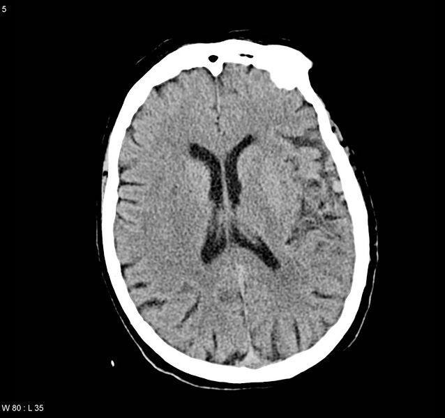 File:Arteriovenous malformation - cerebral (Radiopaedia 8172-9020 Axial non-contrast 13).jpg