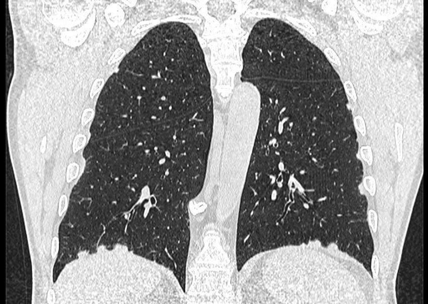 Asbestos pleural placques (Radiopaedia 57905-64872 Coronal lung window 202).jpg