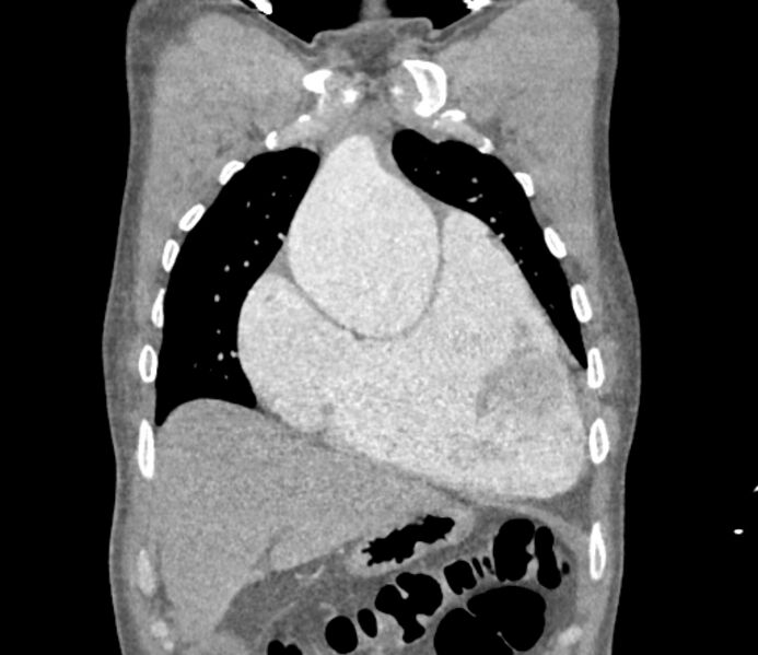 File:Ascending aortic aneurysm (Radiopaedia 86279-102297 B 13).jpg
