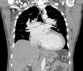 Ascending aortic aneurysm (Radiopaedia 86279-102297 B 34).jpg