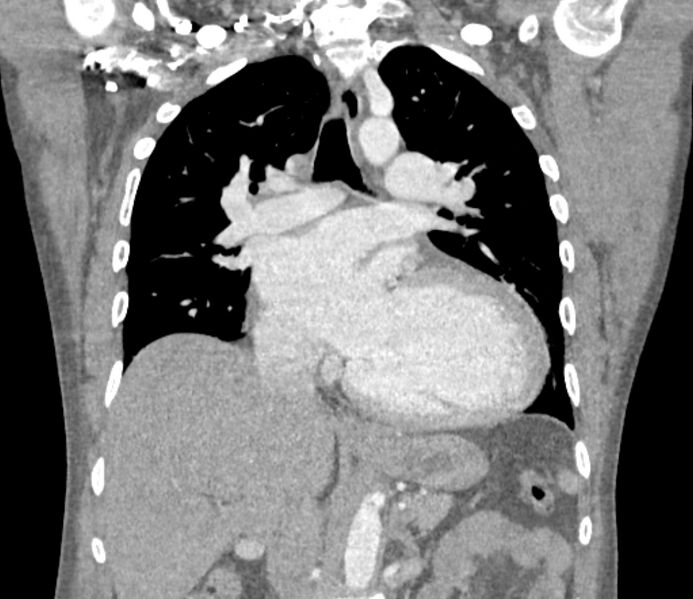 File:Ascending aortic aneurysm (Radiopaedia 86279-102297 B 34).jpg