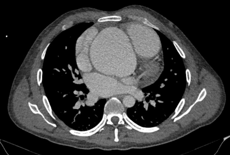 File:Ascending aortic aneurysm (Radiopaedia 86279-102297 C 33).jpg