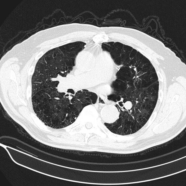 File:Aspergilloma (Radiopaedia 24521-24804 Axial lung window 10).jpg