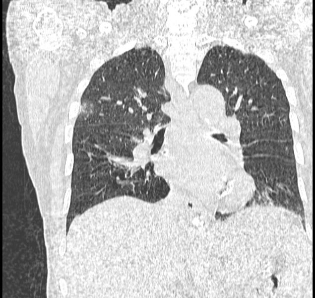 File:Aspergilloma (Radiopaedia 44592-48327 Coronal lung window 74).jpg