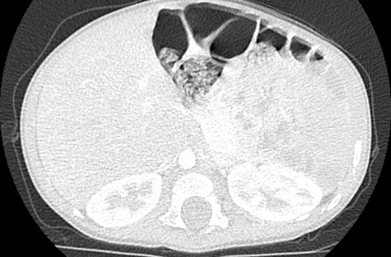 File:Asplenia syndrome (Radiopaedia 73083-83792 Axial lung window 85).jpg
