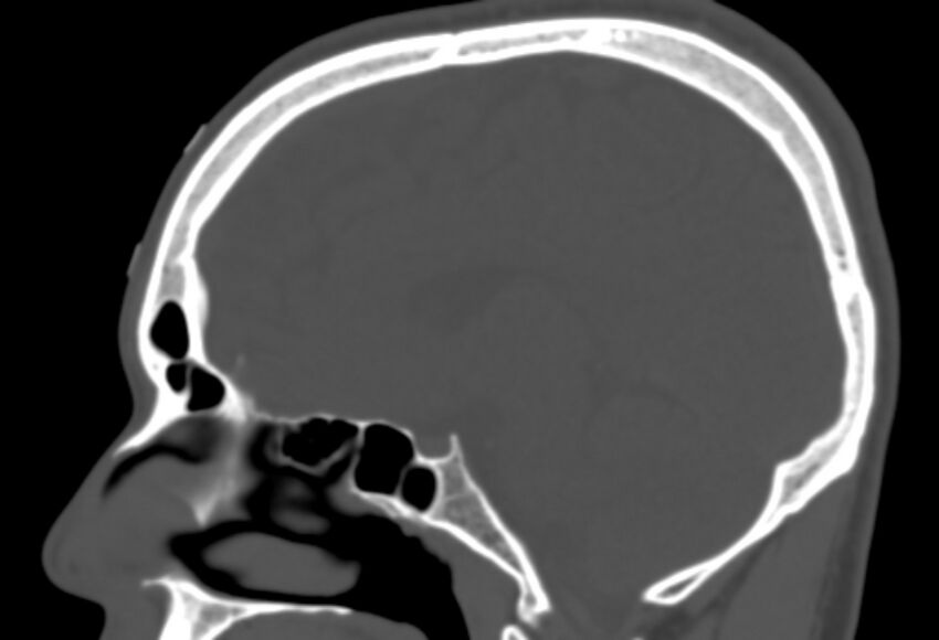 Asymptomatic occipital spur (Radiopaedia 87753-104201 Sagittal bone window 142).jpg