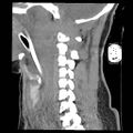 Atlanto-occipital dislocation (Radiopaedia 44648-48412 A 18).jpg