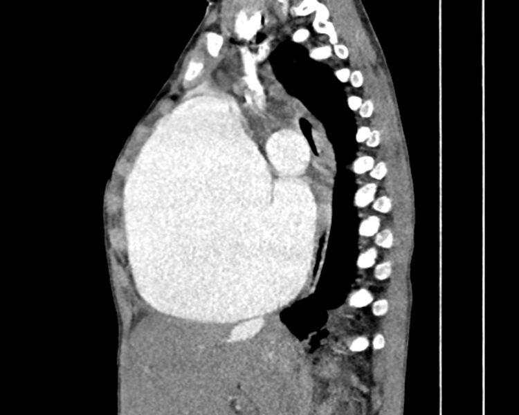 File:Atrial septal defect complicated by Eisenmenger syndrome (Radiopaedia 53707-59768 Sagittal C+ CTPA 12).jpg