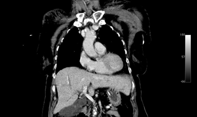 File:Atypical dissection of the thoracic aorta (Radiopaedia 10975-78320 B 5).jpg