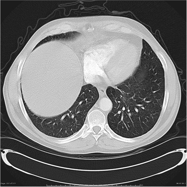 File:Atypical pneumonia - Q fever (Radiopaedia 21993-21989 lung window 36).jpg