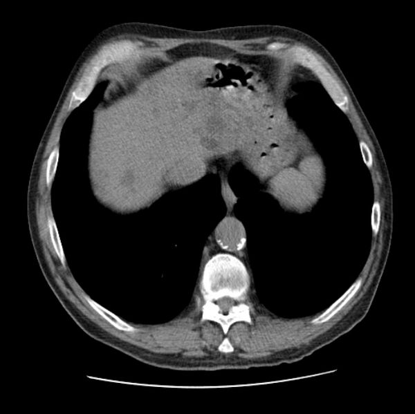 File:Autosomal dominant polycystic kidney disease (Radiopaedia 27851-28094 Axial non-contrast 46).jpg