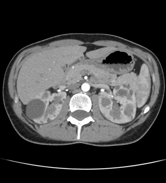 File:Autosomal dominant polycystic kidney disease - early onset (Radiopaedia 40734-43387 B 17).jpg