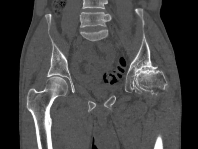 File:Avascular necrosis of the left hip (Radiopaedia 75068-86125 Coronal bone window 28).jpg
