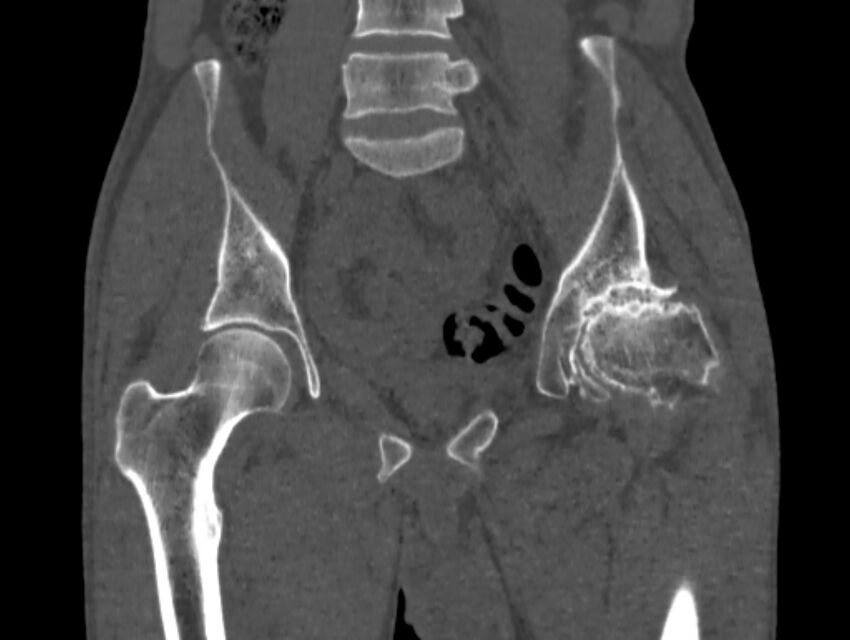 Avascular necrosis of the left hip (Radiopaedia 75068-86125 Coronal bone window 28).jpg